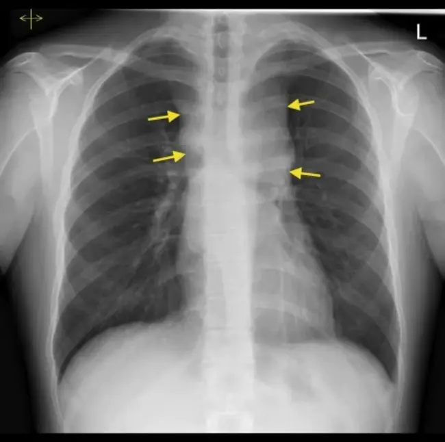 Mediastinal Shift : 纵隔移位