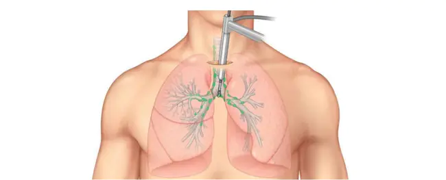 MediastinoScopy : 纵隔镜检查