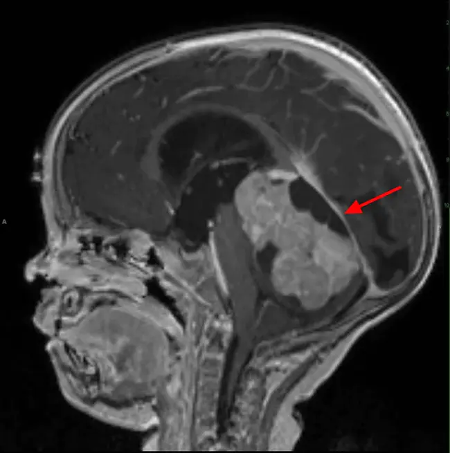 medulloblastoma : 髓母细胞瘤