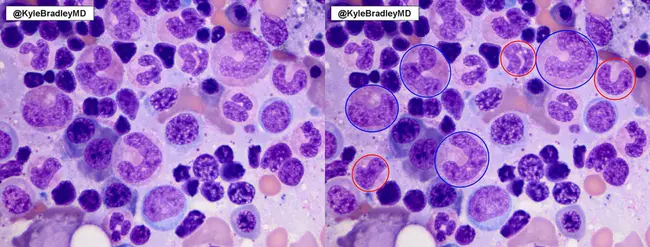 Megaloblastic Anaemia of Pregnancy : 妊娠巨幼细胞贫血