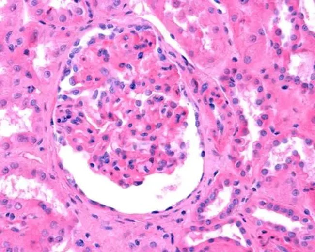 Membranous Glomerulosclerosis : 膜性肾小球硬化