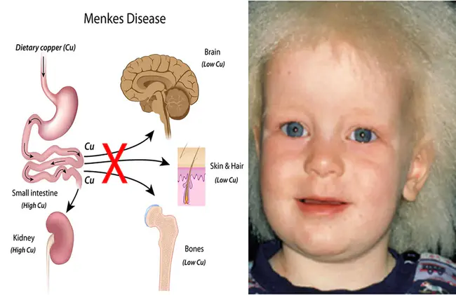 Menkes syndrome : 门克斯综合征