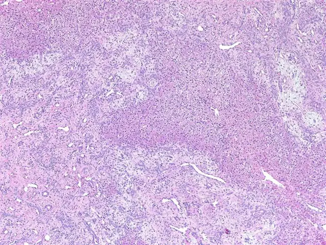 Mesenchymal Hamartoma : 间叶错构瘤