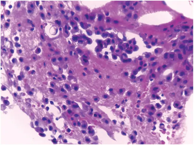 Mesothelial Cell : 间皮细胞