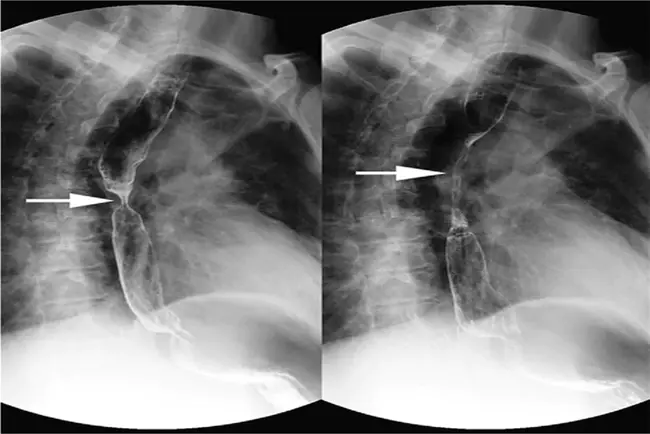 Metastatic Breast Cancer : 转移性乳腺癌