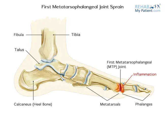 metatarsophalangeal : 跖指骨