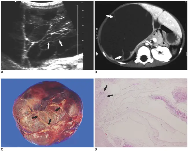 Middle Ear Adenoma : 中耳腺瘤