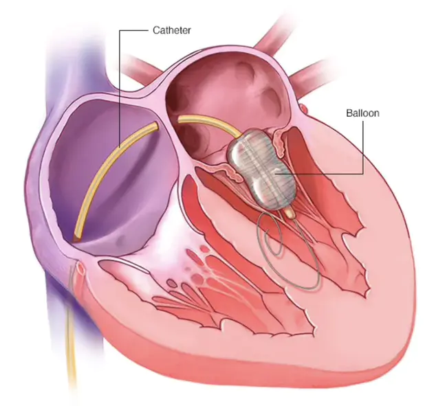 Mitral Balloon Commissurotomy : 二尖瓣球囊联合切开术