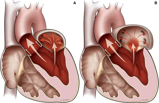 Mitral Sound : 二尖瓣音