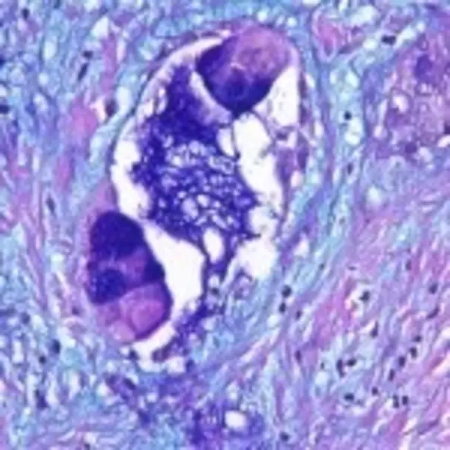 mucoepidermoid carcinoma : 粘液表皮样癌