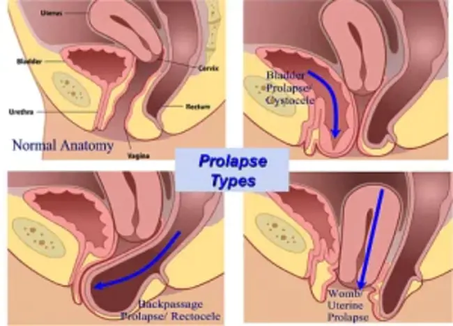 Mucosal Prolapse Syndrome : 粘膜脱垂综合征