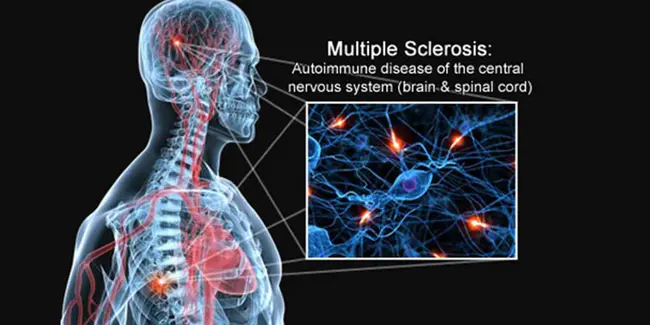 Multiple Hereditary Exostosis : 多发性遗传性外生骨疣