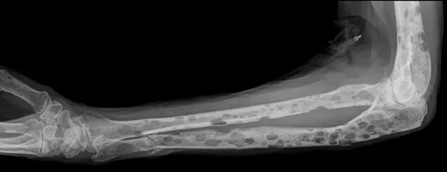 Multiple Osteochondromas : 多发性骨软骨瘤