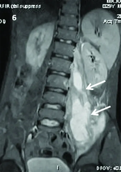 Muscular Subaortic Stenosis : 肌皮质下狭窄