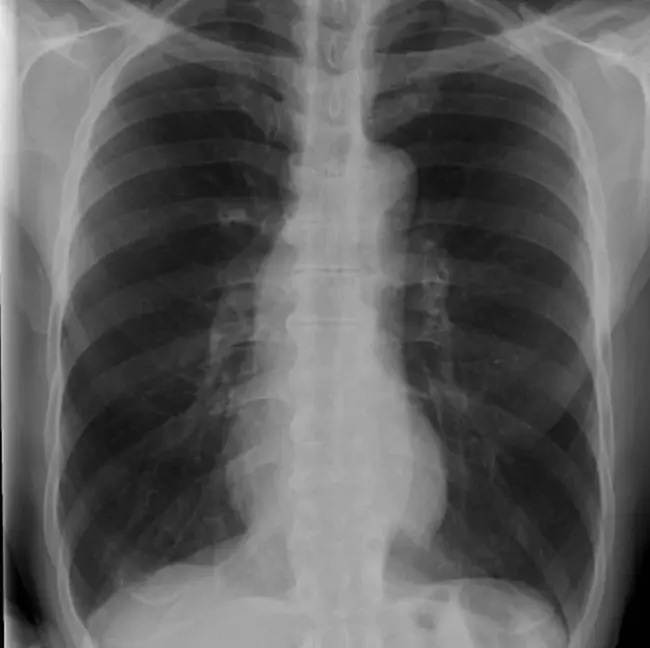 Mycoplasma pneumoniae : 肺炎支原体