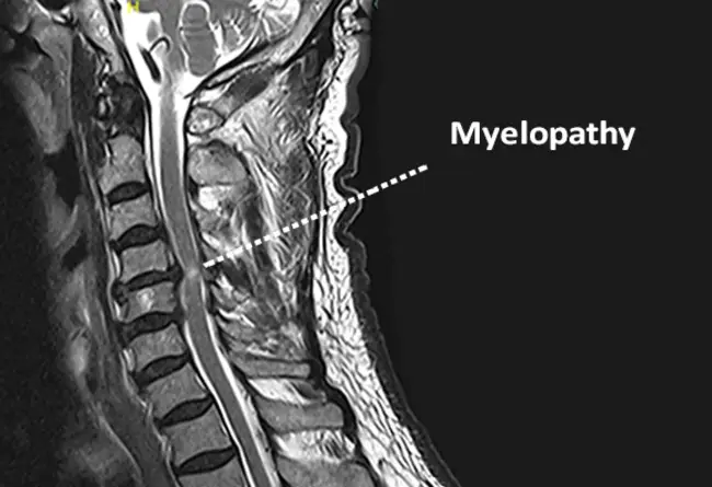 myelopathy : 脊髓病