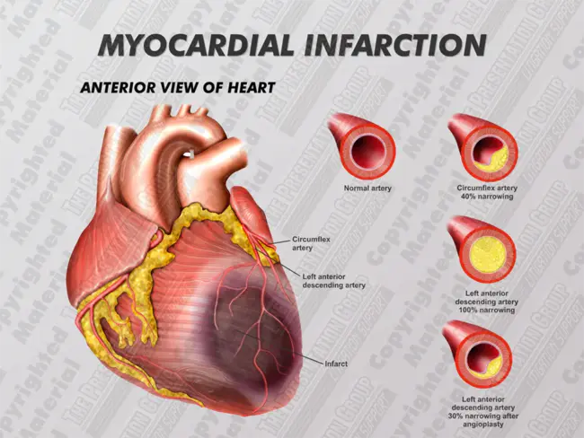 Myocardial Damage : 心肌损伤