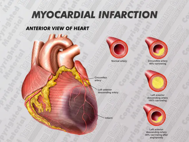 Myocardial Metabolic Rate : 心肌代谢率