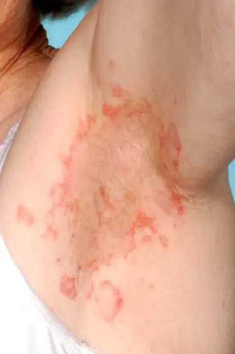 Necrolytic Migratory Erythema : 坏死性移行性红斑