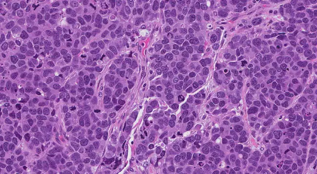 neuroendocrine cell : 神经内分泌细胞