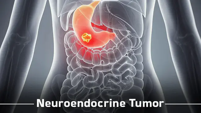 neuroendocrine tumour : 神经内分泌肿瘤