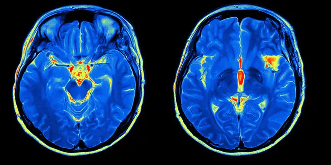 neuroimaging : 神经影像学