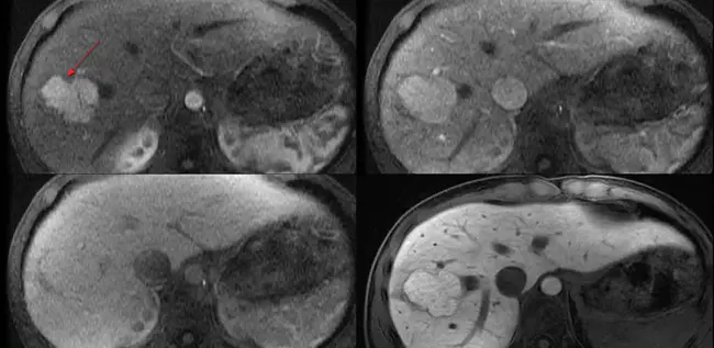 Nodular Lymphoid Hyperplasia : 结节性淋巴增生