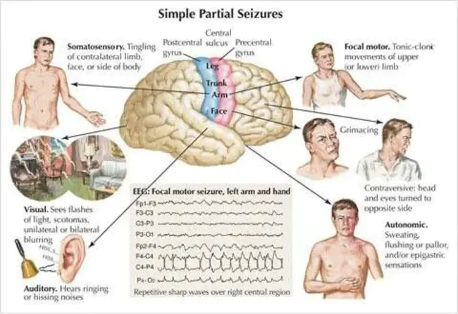 Non-Epileptic Seizure : 非癫痫发作