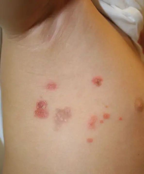 Nonbullous Congenital Ichthyosiform Erythroderma : 非大疱性先天性鱼鳞状红皮病