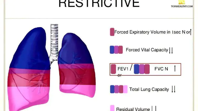 Obstructive Pulmonary Disease : 阻塞性肺疾病