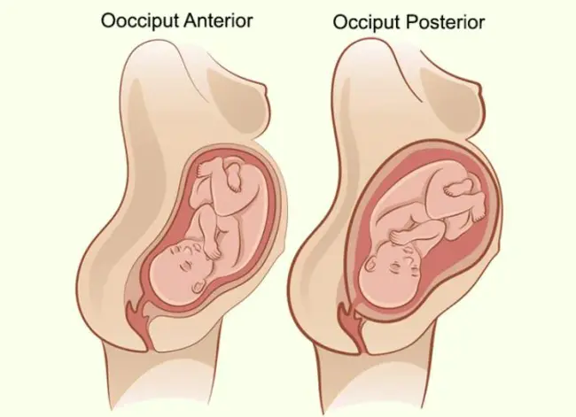 Occiput Anterior : 枕前