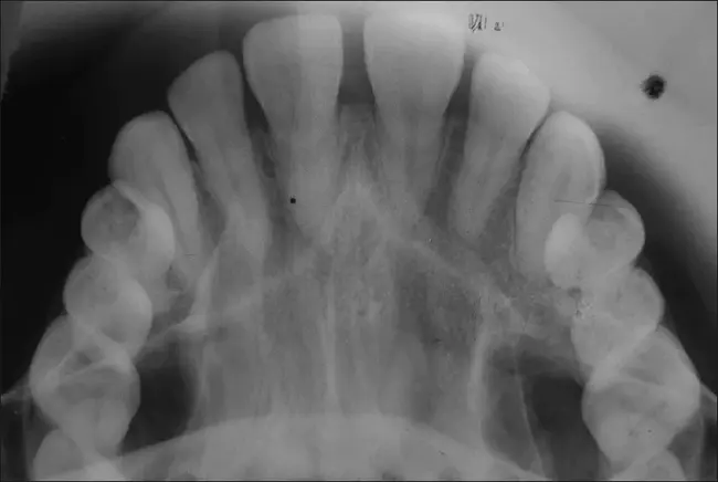 Occlusal Plane : 牙合面