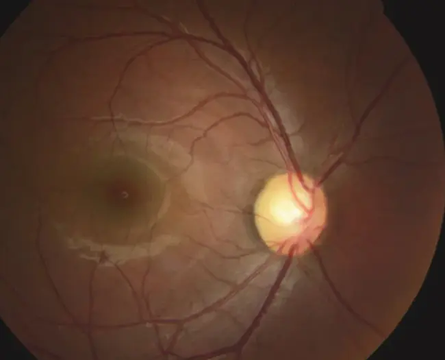 ocular plethysmography : 眼体积描记术