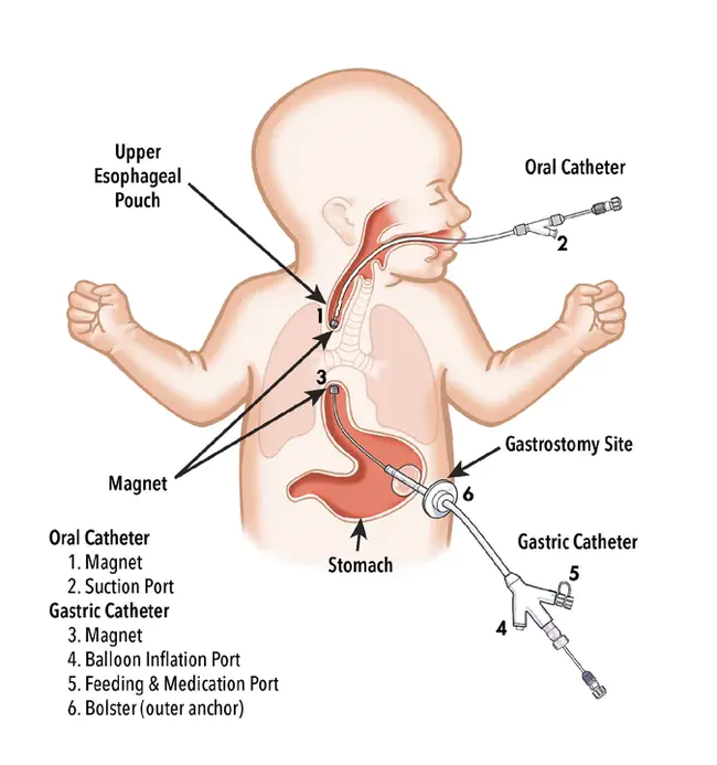 Oesophageal Atresia : 食道闭锁