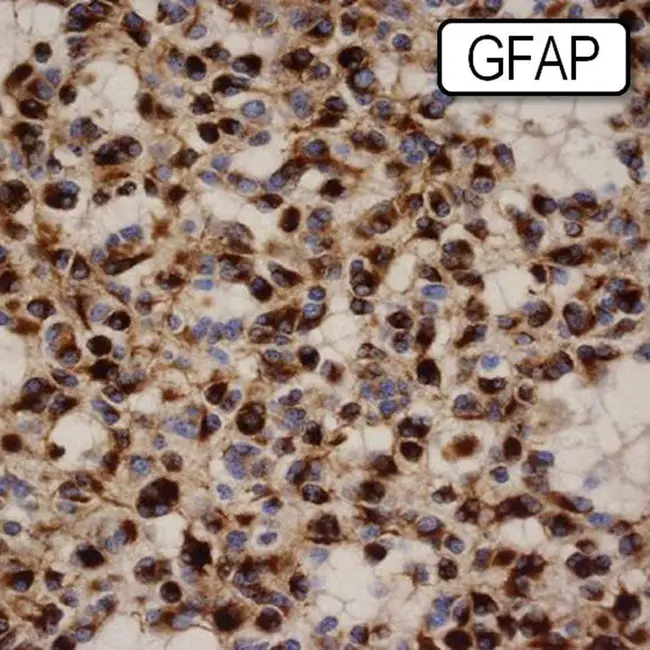 oligoastrocytoma : 少星形细胞瘤