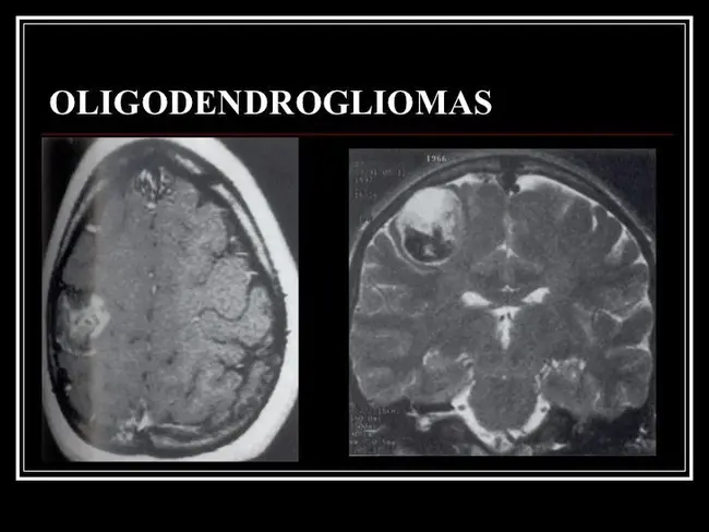 Oligodendrogliomas : 少枝胶质细胞瘤