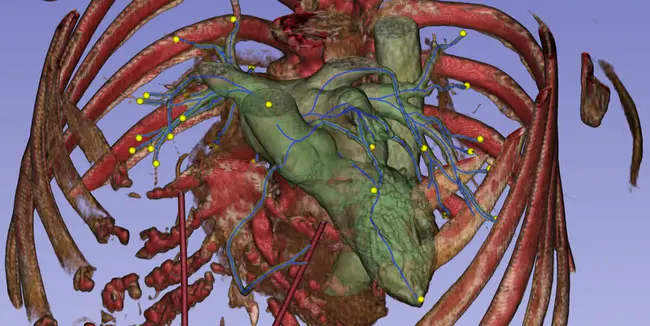 Open Artery Trial : 开放动脉试验