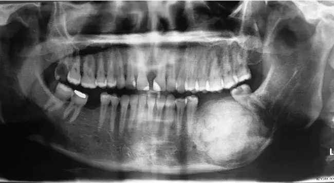 Ossifying Fibroma : 骨化纤维瘤