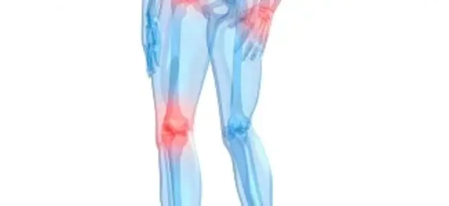 osteoarticular tuberculosis : 骨关节结核