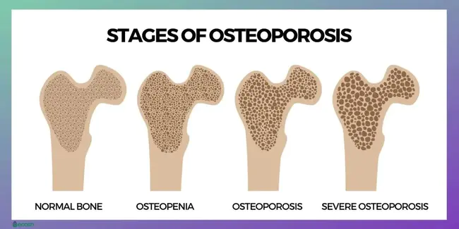 osteopaenia : 骨性骨质增生