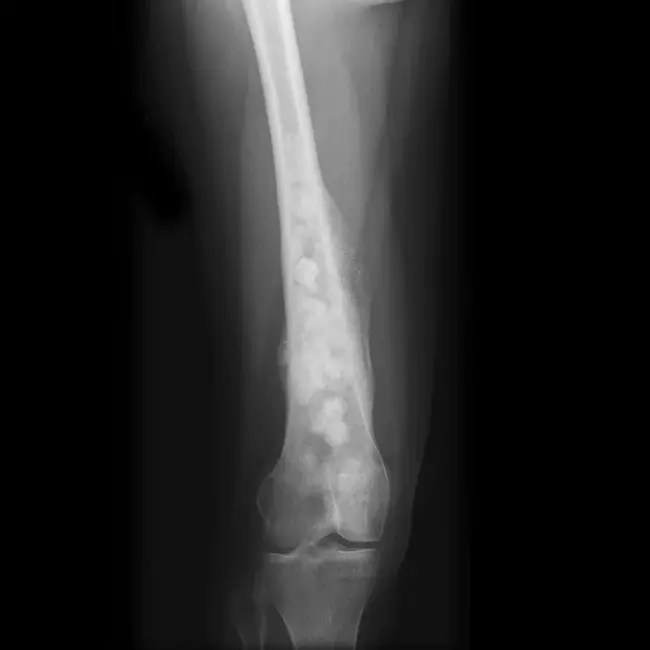 osteosarcoma : 骨肉瘤