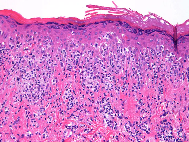 Pagetoid Reticulosis : 页状网织病