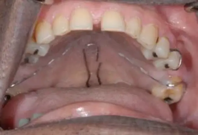 Palatal Lift Prosthesis : 腭升假体