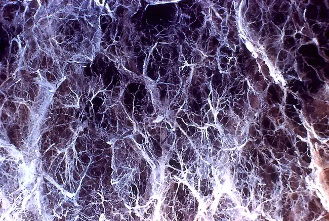 panlobular emphysema : 小叶盘状肺气肿