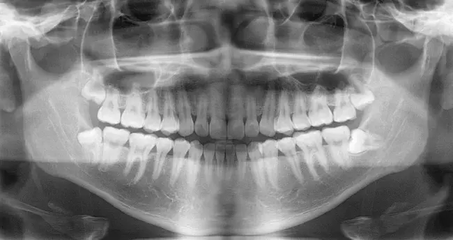 Panoramic Mandibular Index : 下颌全景指数