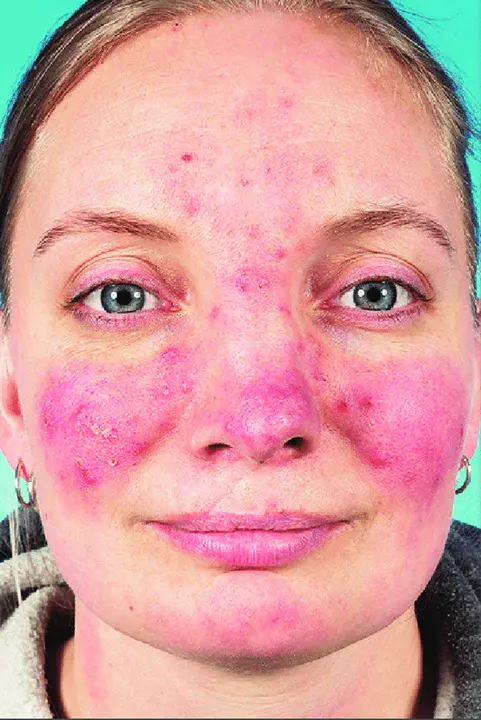 papulopustular rosacea : 丘疹口酒渣鼻