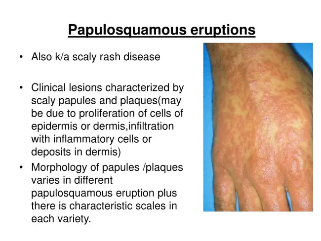 Papulosquamous : 丘疹鳞状的