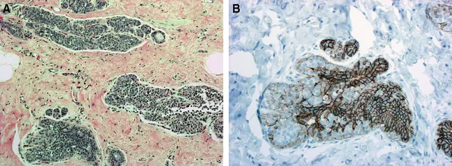 ParaCortical hyperplasia : 皮质旁增生