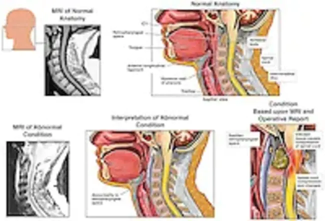 parapharyngeal space : 咽旁间隙
