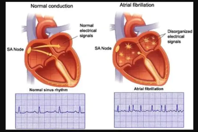 Paroxysmal Atrial Fibrillation : 阵发性房颤